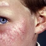 Alles over Zonneallergie, Warmteallergie en Warmtebultjes bij Baby’s en Kinderen