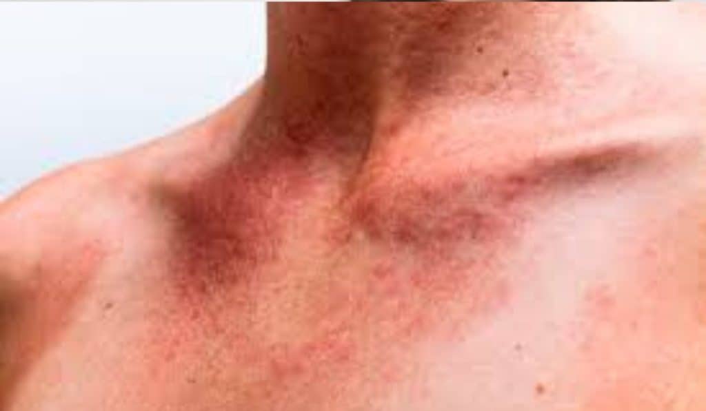 Warmtebultjes en Zonneallergie