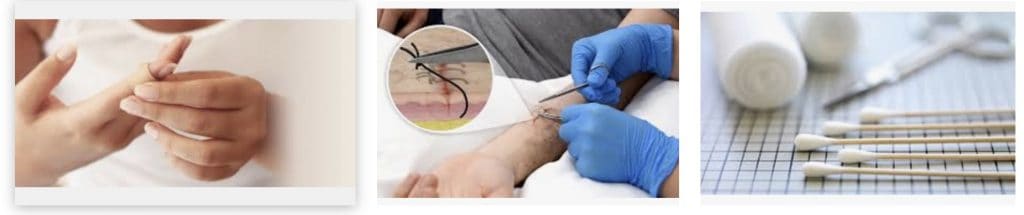 Een goede wondverzorging is belangrijker dan je denkt